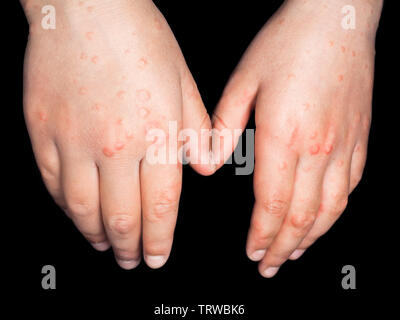 Enfant avec des taches rouges de Coxsackievirus, sur les deux mains, les mains derrière, isolated on black Banque D'Images