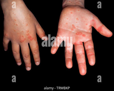 Enfant avec des taches rouges de Coxsackievirus, sur les deux mains, isolé sur fond noir Banque D'Images