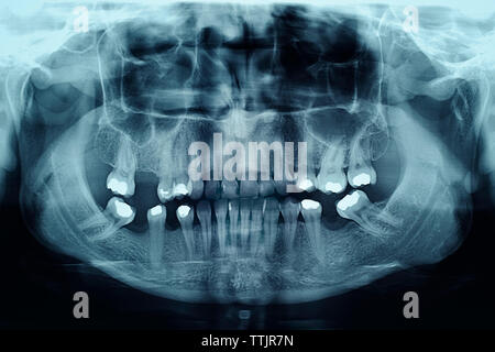 La radiographie dentaire Obturations montrant dans les dents Banque D'Images
