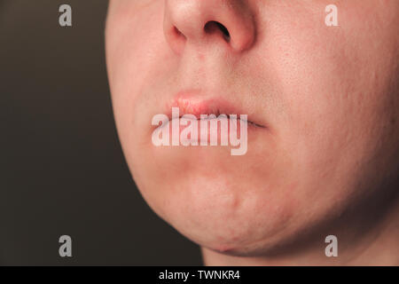 Deuxième jour de plus en plus sur l'herpès caucasien homme homme sur la lèvre supérieure avant Banque D'Images