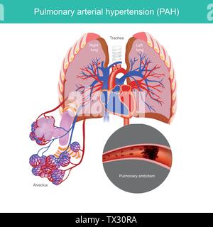 L'état de haute pression sanguine dans les artères qui vont de votre coeur à vos poumons. Illustration de Vecteur