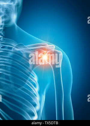 Médicalement en rendu 3d illustration d'un précis de l'épaule douloureuse Banque D'Images