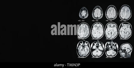 Bannière. Irm du cerveau d'une personne en bonne santé sur un fond noir avec rétroéclairage gris. Sur le côté gauche de la publicité sous l'inscription. Banque D'Images