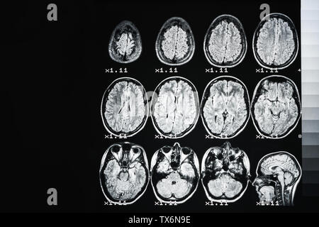 Irm du cerveau d'une personne en bonne santé sur un fond noir avec rétroéclairage gris. Antécédents médicaux Banque D'Images