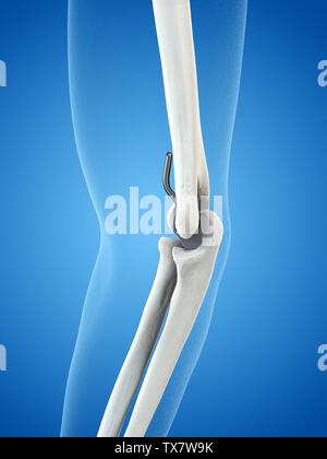 Médicalement en rendu 3d illustration précise d'un remplacement du coude Banque D'Images
