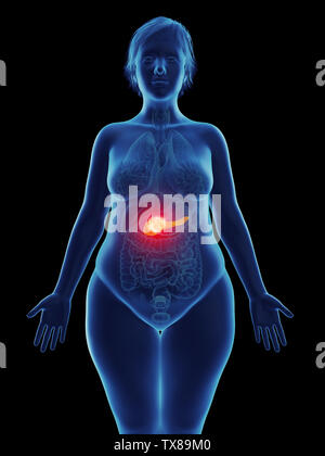 Médicalement en rendu 3d illustration d'un précise dans une tumeur du pancréas womans Banque D'Images