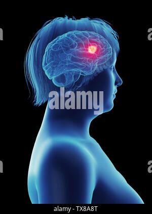 Médicalement en rendu 3d illustration d'un précis d'une tumeur dans un cerveau de femme Banque D'Images