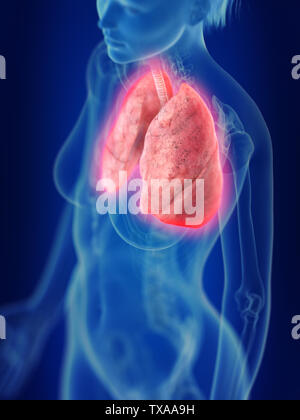 Médicalement en rendu 3d illustration d'une inflammation des poumons Banque D'Images