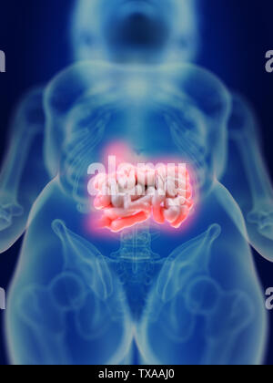 Rendu 3D précis médicalement illustration d'un intestin enflammé Banque D'Images