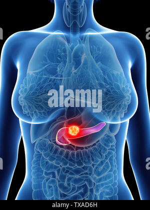 Rendu 3D précis médicalement illustration d'un cancer du pancréas womans Banque D'Images