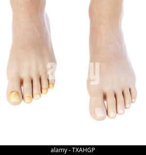 Médicalement, rendu 3d illustration précise de toe nail fungus Banque D'Images