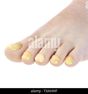 Médicalement, rendu 3d illustration précise de toe nail fungus Banque D'Images
