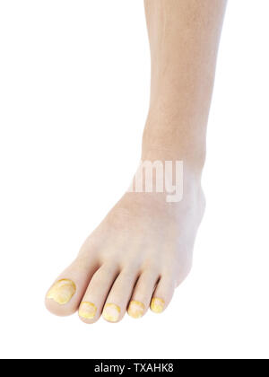 Médicalement, rendu 3d illustration précise de toe nail fungus Banque D'Images