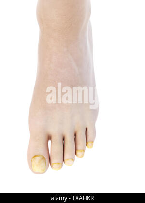 Médicalement, rendu 3d illustration précise de toe nail fungus Banque D'Images