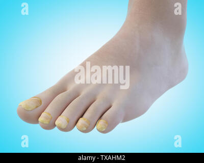 Médicalement, rendu 3d illustration précise de toe nail fungus Banque D'Images