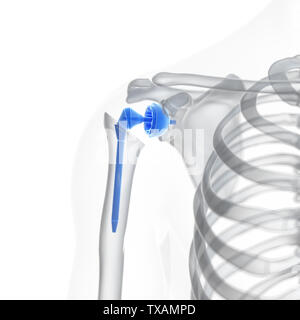 Rendu 3D précis médicalement illustration d'un remplacement de l'épaule Banque D'Images