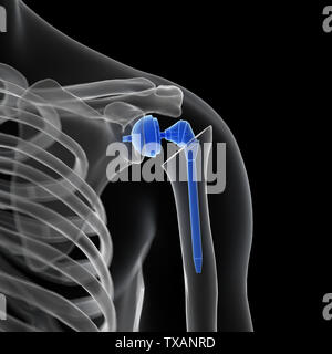 Rendu 3D précis médicalement illustration d'un remplacement de l'épaule Banque D'Images