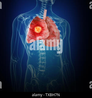 Médicalement en rendu 3d illustration précise du cancer du poumon Banque D'Images