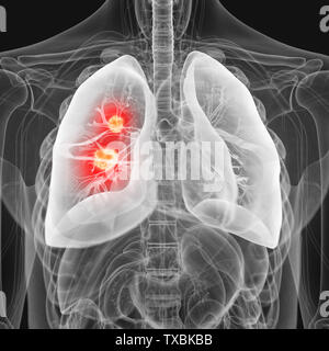 Médicalement en rendu 3d illustration précise du cancer du poumon Banque D'Images