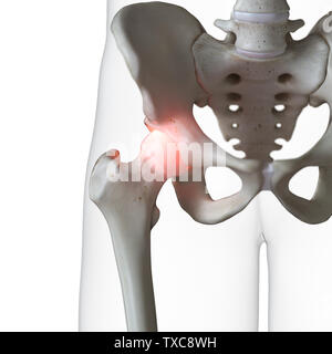 Rendu 3D précis médicalement illustration d'une hanche douloureuse Banque D'Images