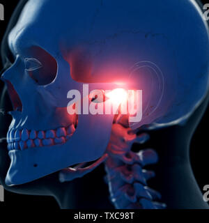 Médicalement en rendu 3d illustration d'un précise une douloureuse de l'articulation temporomandibulaire Banque D'Images