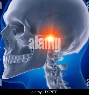 Médicalement en rendu 3d illustration d'un précis de l'articulation temporomandibulaire douloureux Banque D'Images
