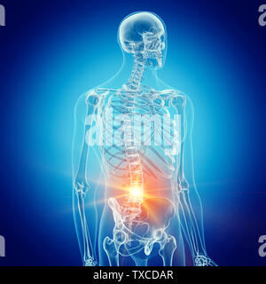 Médicalement en rendu 3d illustration d'un précis de la colonne lombaire douloureuse Banque D'Images