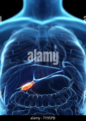 Médicalement en rendu 3d illustration d'un précis de la vésicule biliaire malade Banque D'Images