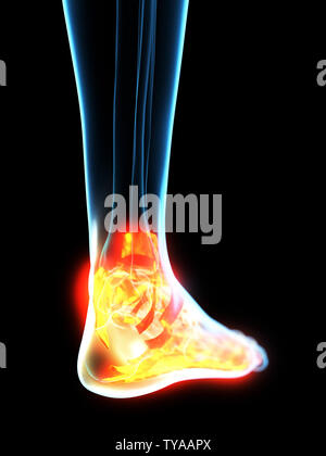 Médicalement en rendu 3d illustration de l'inflammation des ligaments précis Banque D'Images