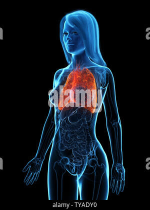 Médicalement en rendu 3d illustration d'un précis poumon malade Banque D'Images