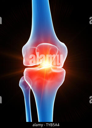 Médicalement en rendu 3d illustration précise de l'articulation du genou montrant la douleur Banque D'Images