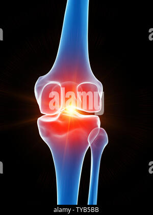 Médicalement en rendu 3d illustration précise de l'articulation du genou montrant la douleur Banque D'Images