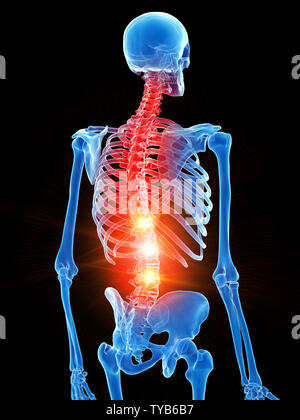 Rendu 3D précis médicalement illustration de la douleur squelettique thorax montrant Banque D'Images