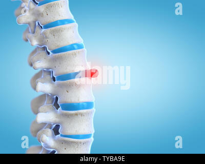 Médicalement en rendu 3d illustration précise d'une hernie discale Banque D'Images