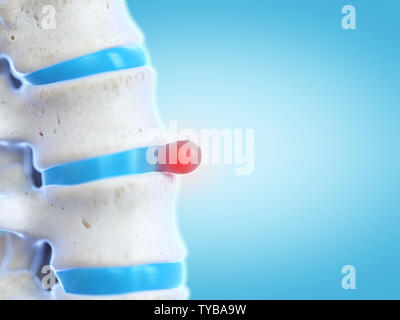 Médicalement en rendu 3d illustration précise d'une hernie discale Banque D'Images