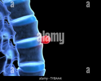 Médicalement en rendu 3d illustration précise d'une hernie discale Banque D'Images