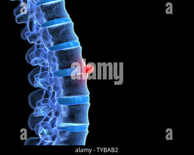 Médicalement en rendu 3d illustration précise d'une hernie discale Banque D'Images