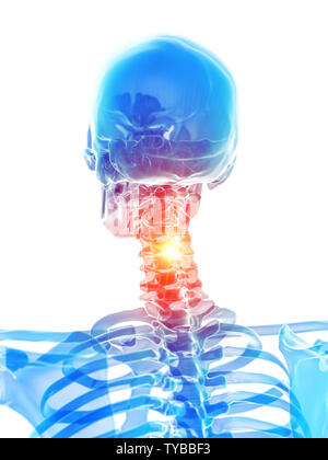 Médicalement en rendu 3d illustration précise de la colonne cervicale montrant la douleur Banque D'Images