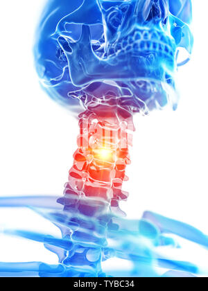 Rendu 3D précis médicalement illustration de la douleur cervicale cou montrant Banque D'Images