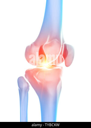 Médicalement en rendu 3d illustration précise de l'articulation du genou montrant la douleur Banque D'Images