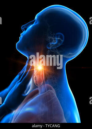 Médicalement en rendu 3d illustration d'un homme juste avoir un mal de gorge Banque D'Images