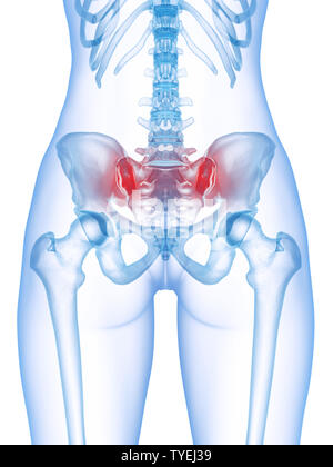 Rendu 3D précis médicalement illustration d'une articulation sacro-iliaque douloureux Banque D'Images