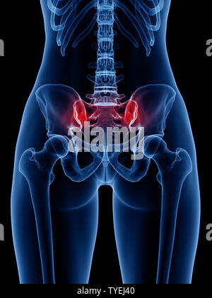 Rendu 3D précis médicalement illustration d'une articulation sacro-iliaque douloureux Banque D'Images
