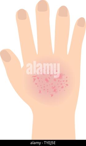 L'eczéma a affecté une part de dermatologie maladies de peau concept vector illustration isolé sur fond blanc Illustration de Vecteur