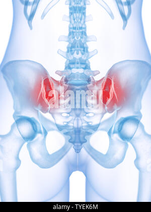 Rendu 3D précis médicalement illustration d'une articulation sacro-iliaque douloureux Banque D'Images