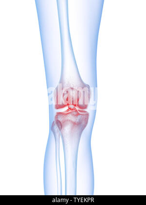 Médicalement en rendu 3d illustration d'un précise du genou douloureux Banque D'Images