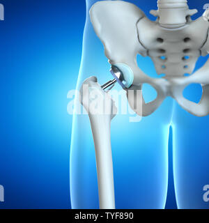 Rendu 3d illustration d'un implant de hanche Banque D'Images