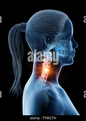 Rendu 3d illustration d'un cou douloureux chez les femmes Banque D'Images