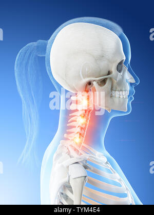 Rendu 3d illustration d'un cou douloureux chez les femmes Banque D'Images