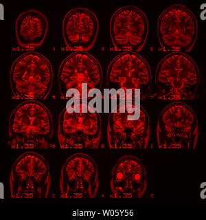 Irm du cerveau sur un fond noir avec rétroéclairage rouge. Square photo Banque D'Images